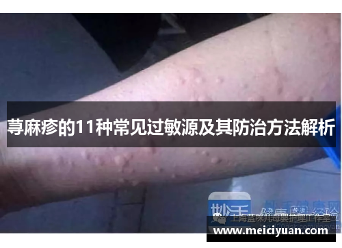 荨麻疹的11种常见过敏源及其防治方法解析